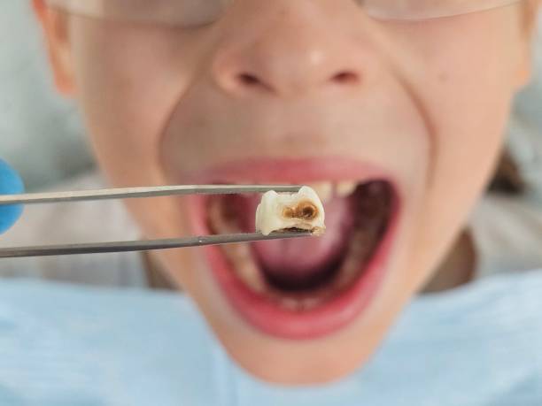 Best Broken or Cracked Tooth Emergency Dentist in Seaford, NY