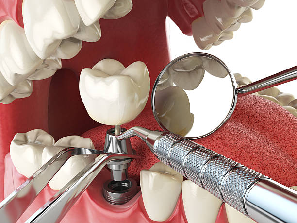 Best Emergency Root Canal Treatment in Seaford, NY
